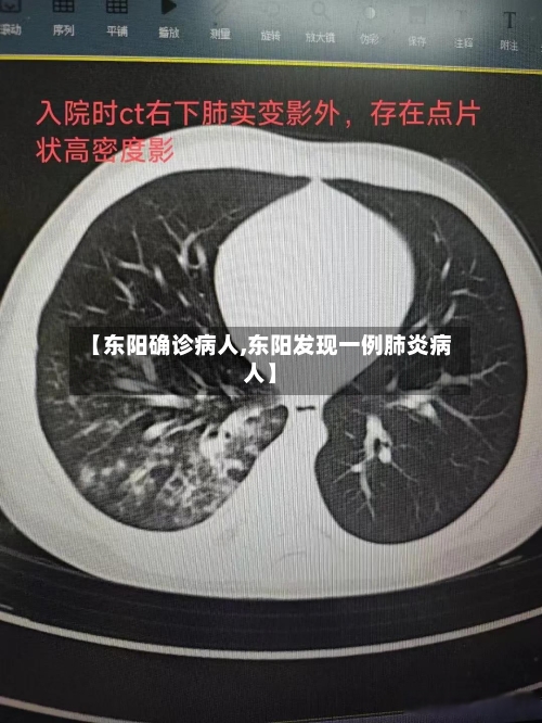 【东阳确诊病人,东阳发现一例肺炎病人】