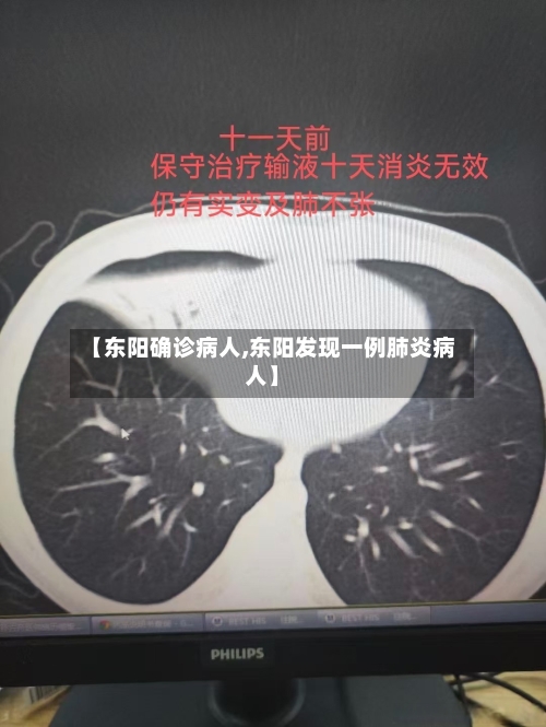 【东阳确诊病人,东阳发现一例肺炎病人】-第3张图片